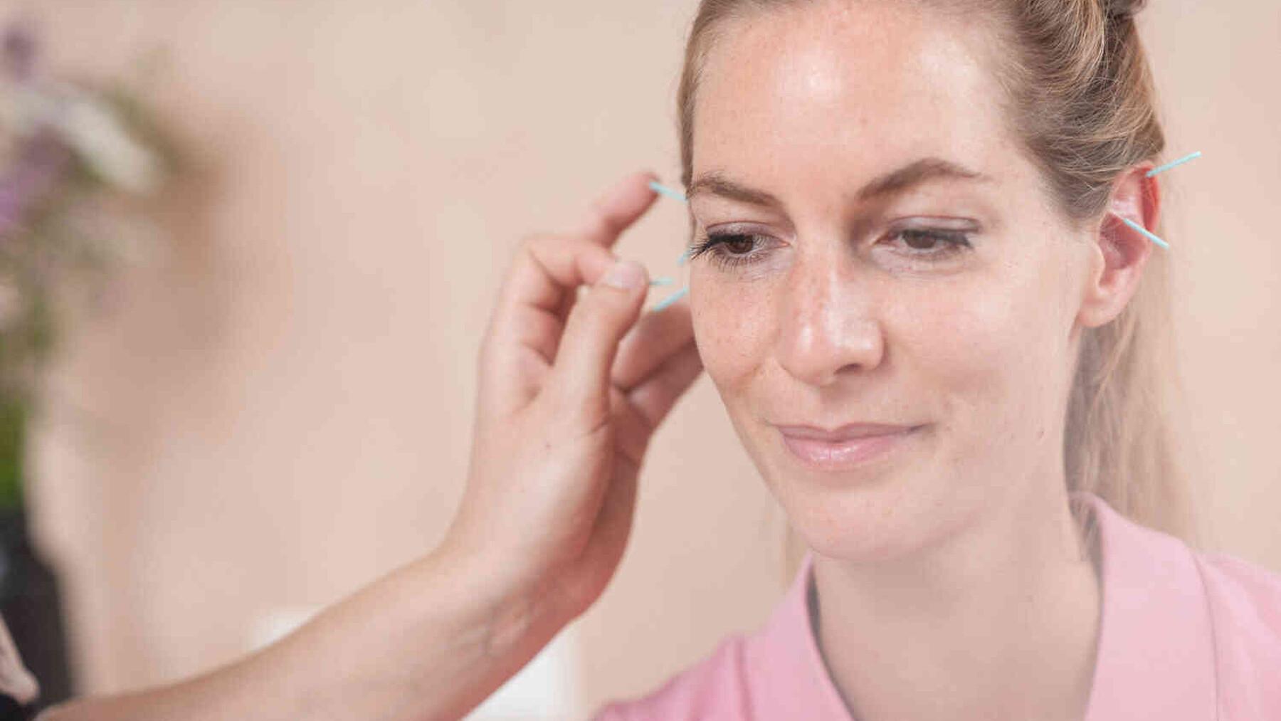 Frau bekommt Akupunkturnadeln im Ohr gesetzt